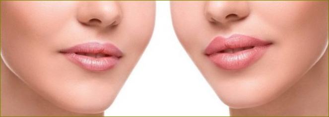Lūpos padidintos užpildais (prieš ir po)